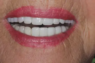 A finished case at Signature Dental Group, Delray Beach.