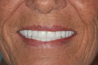A finished case at Signature Dental Group, Delray Beach.