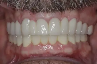 A finished case at Signature Dental Group, Delray Beach.