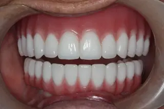 A finished case at Signature Dental Group, Delray Beach.