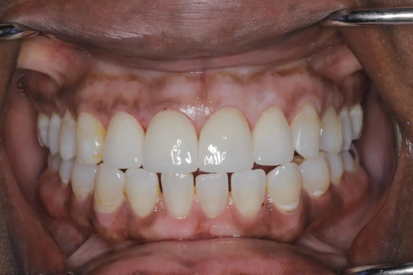 The same patient after treatment at Signature Dental Group, with matched ceramic restorations.