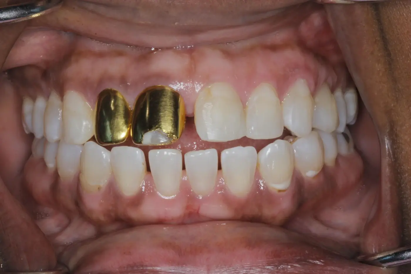 A patient's upper teeth before treatment, with two gold crowns at the front.
